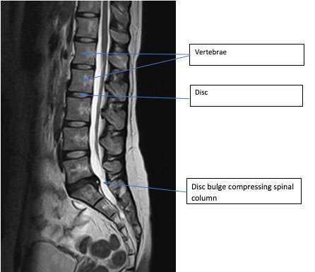 disc bulge