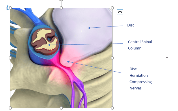 disc bulge2