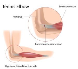 Tennis Elbow